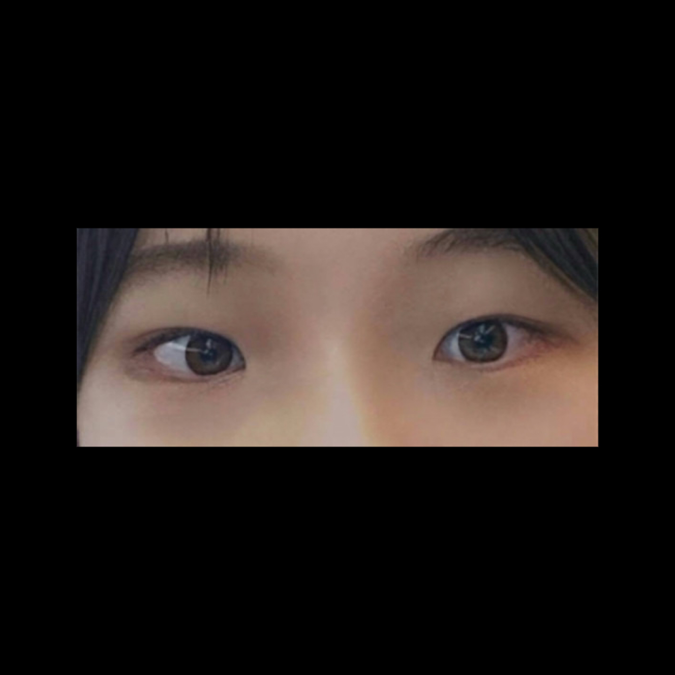 쌍꺼풀(매몰) 후기
