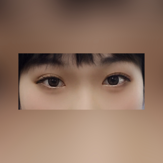 눈재수술 후기
