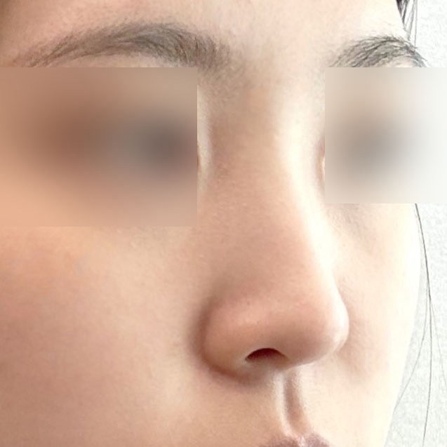 낮은코성형 후기
