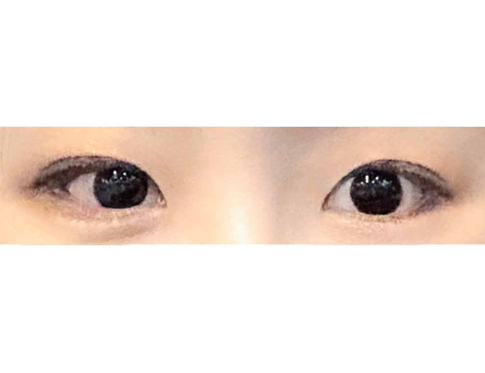 밑트임 후기