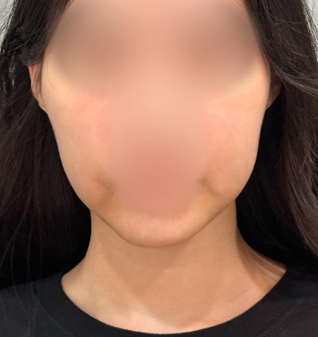 실리프팅 후기