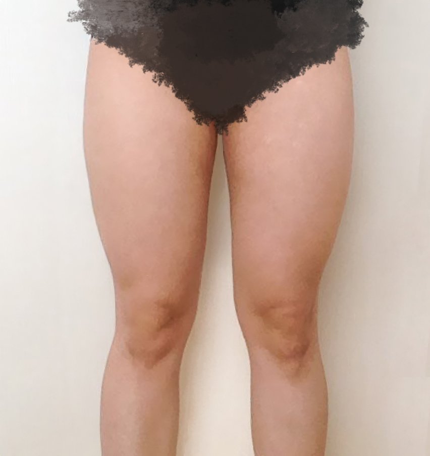 허벅지지방흡입 후기