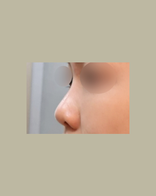 코재수술 후기