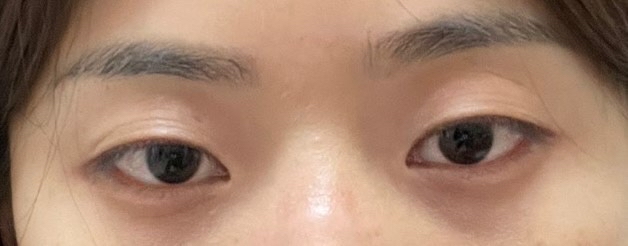눈매교정 후기