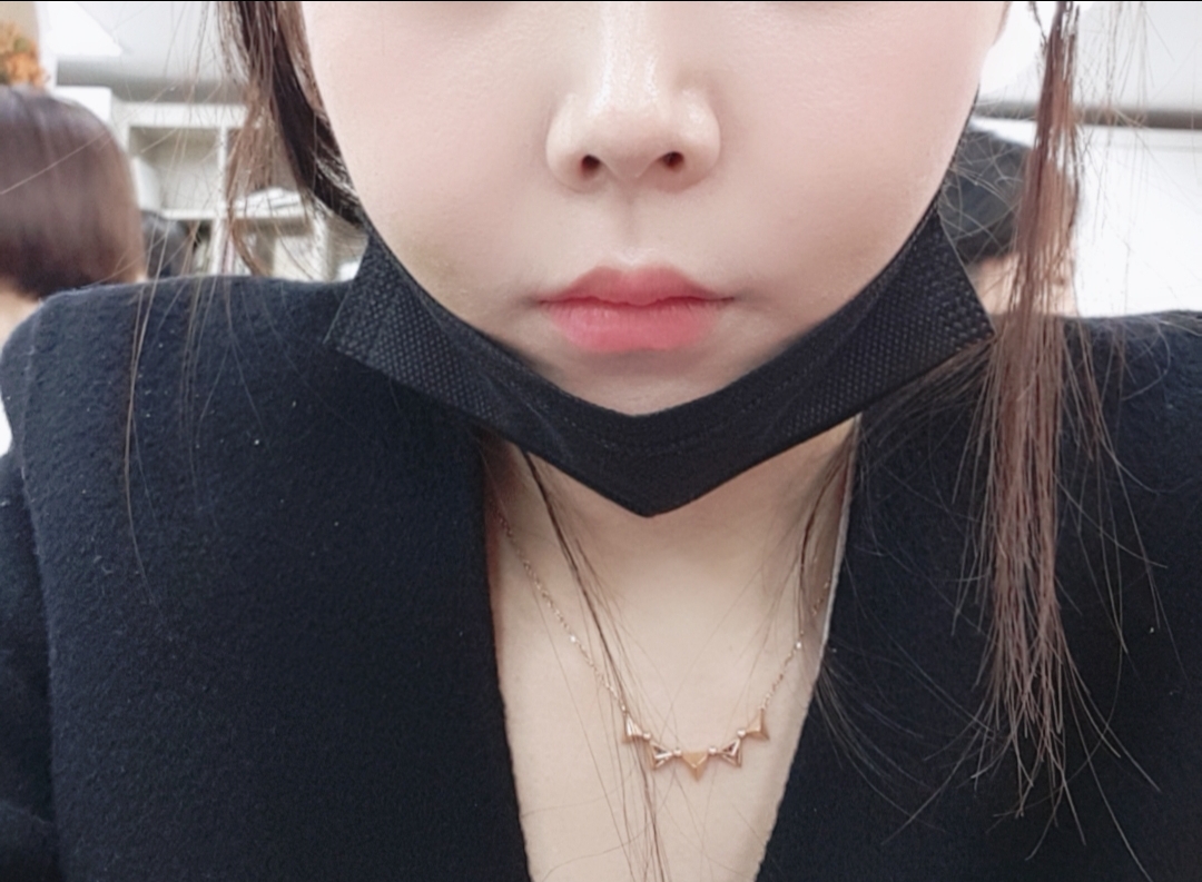 인중축소술 후기