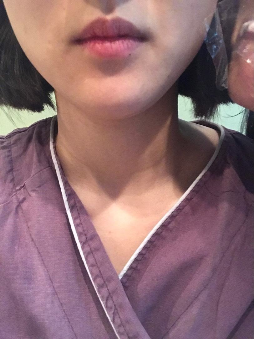 입꼬리성형 후기