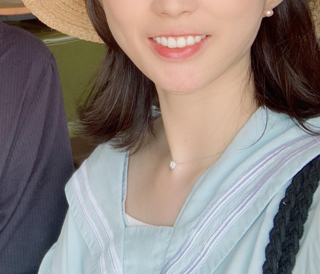 인중축소술 후기