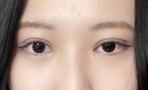 눈재수술 후기