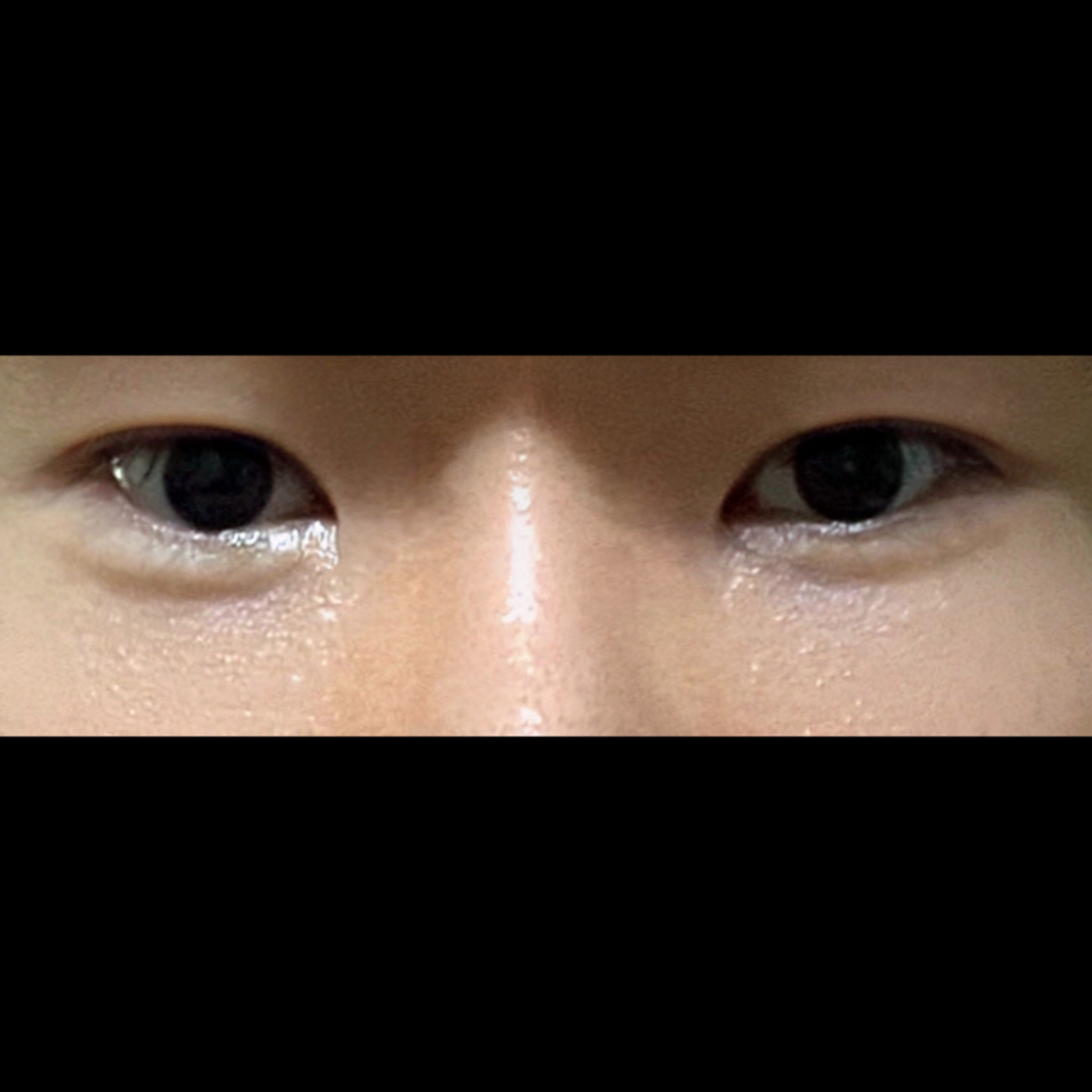 밑트임 후기