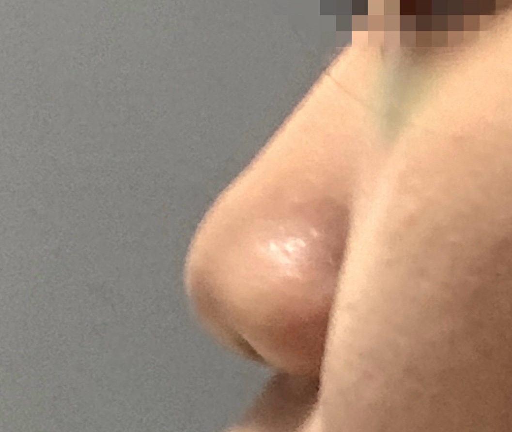 콧대(보형물) 후기