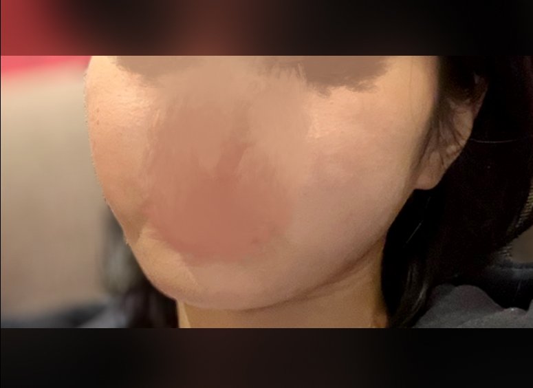 윤곽주사 후기