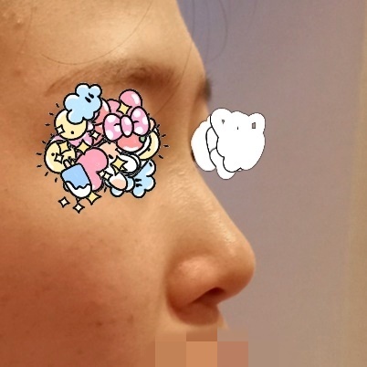 콧대(보형물) 후기