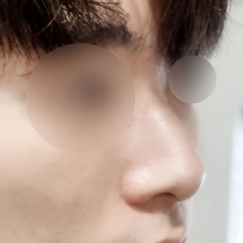 콧대(보형물) 후기
