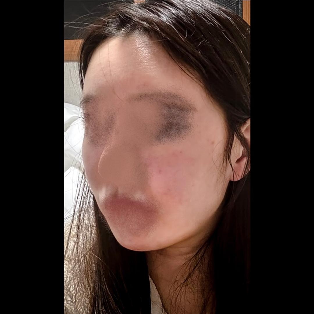 실리프팅 후기