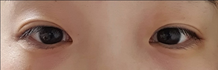 눈재수술 후기