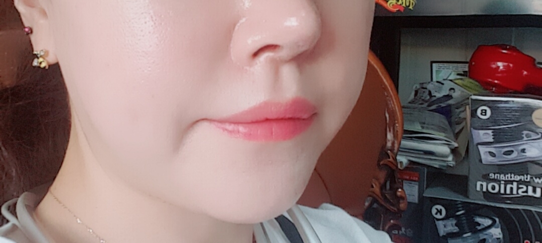 입꼬리성형 후기