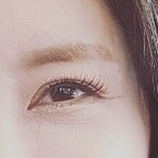 눈재수술 후기