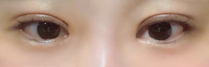 눈재수술 후기