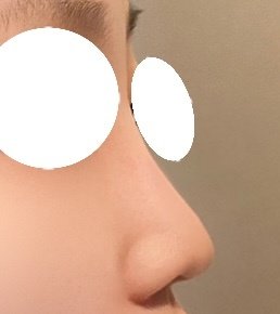 콧볼축소 후기