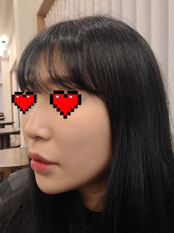 콧대(보형물) 후기