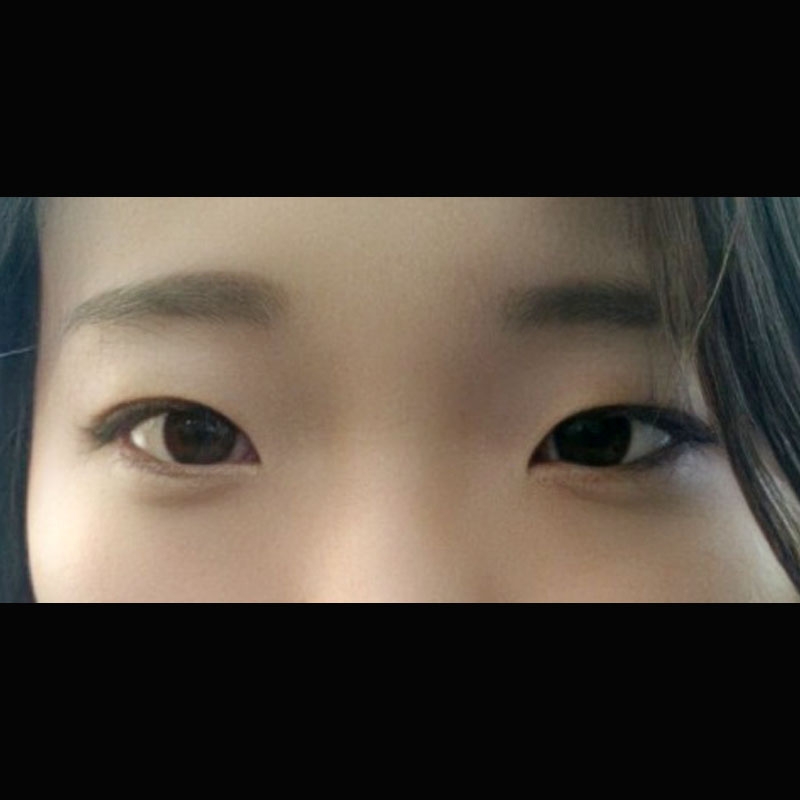 쌍꺼풀(절개) 후기