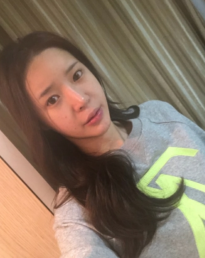 눈재수술 후기