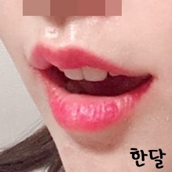 입꼬리성형 후기
