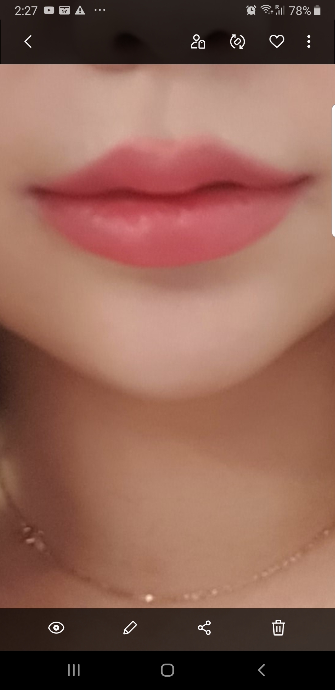 입꼬리성형 후기