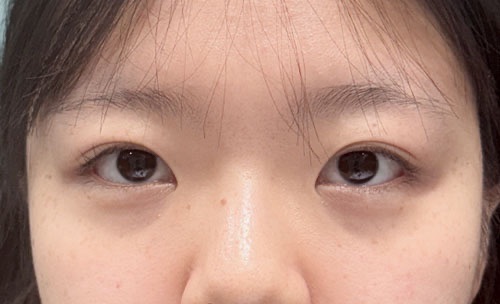 쌍꺼풀(자연유착) 후기