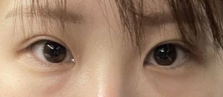 밑트임 후기