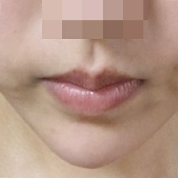 입꼬리성형 후기