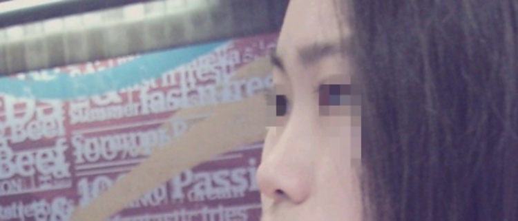 콧대(보형물) 후기