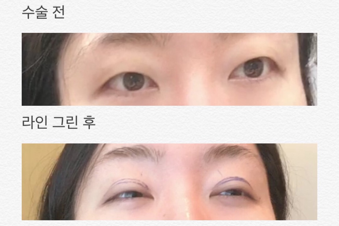 쌍꺼풀(절개) 후기
