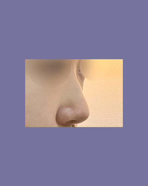 코절골술 후기