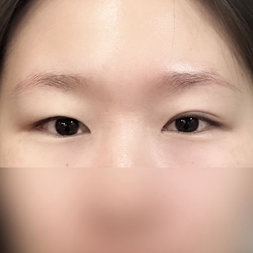 눈재수술 후기