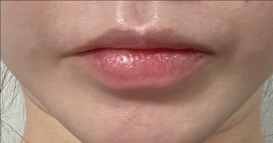 입꼬리성형 후기