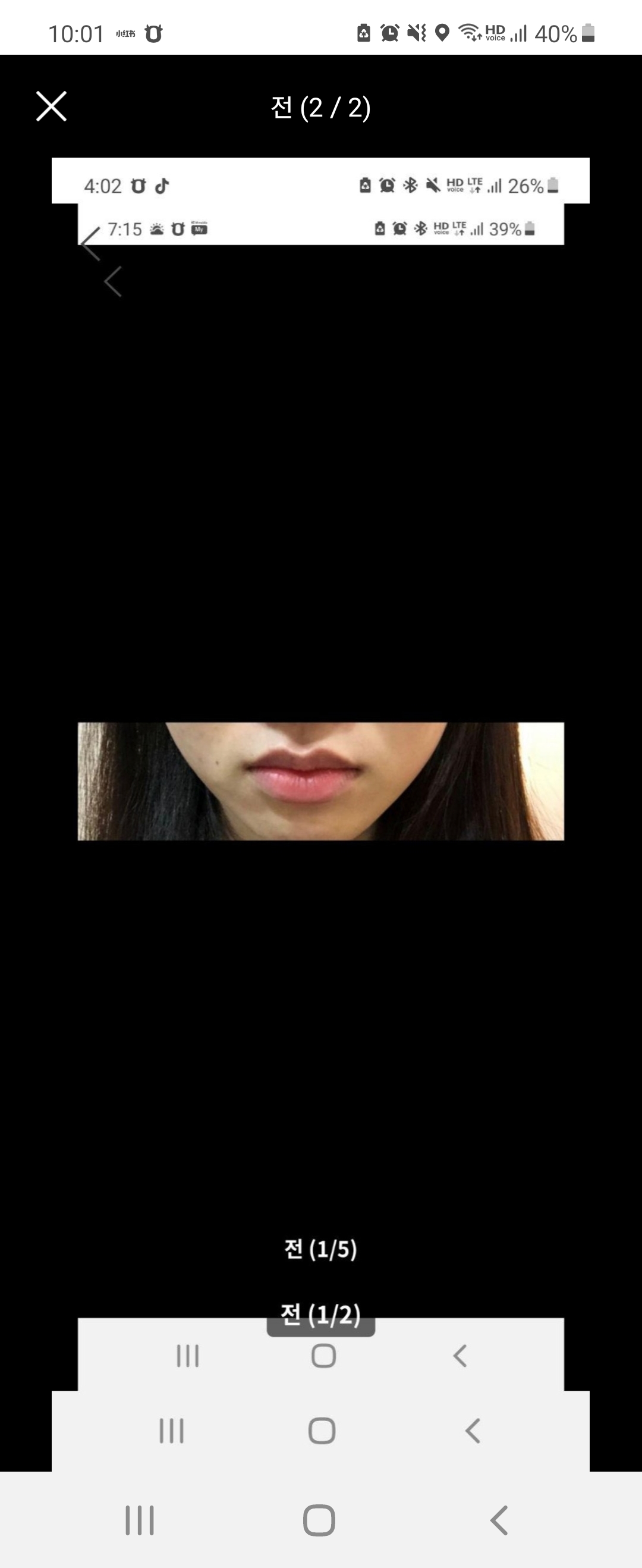 입꼬리필러 후기