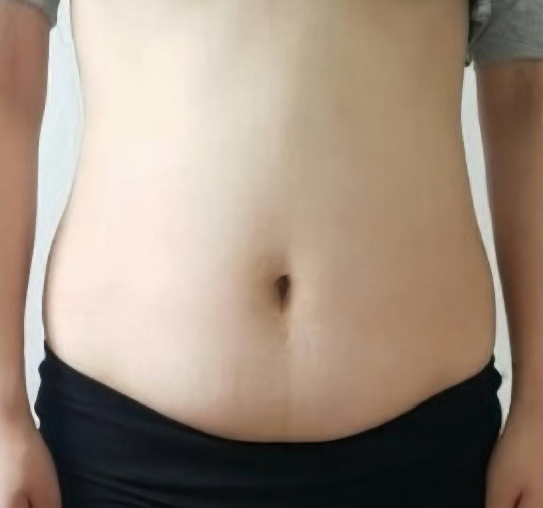 복부지방흡입 후기