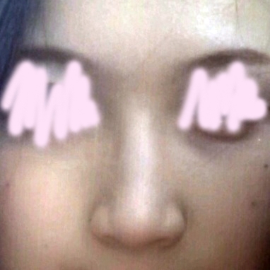 콧대(보형물) 후기