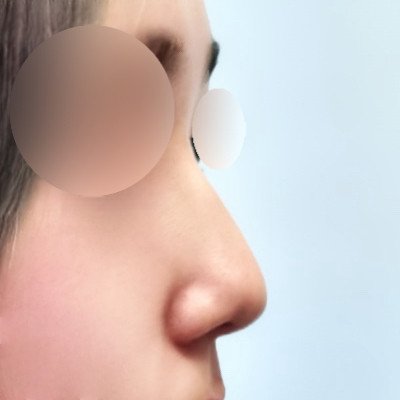 코끝(기증연골) 후기