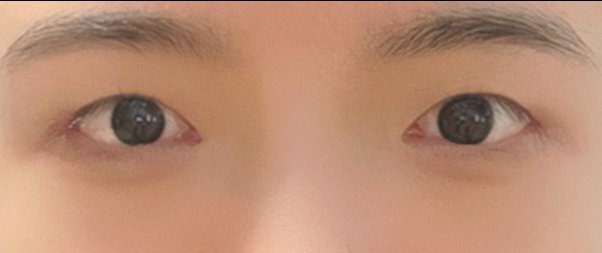 쌍꺼풀(절개) 후기