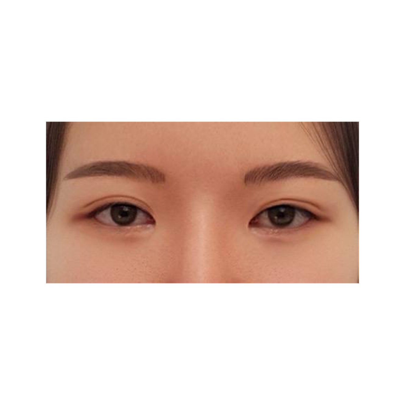 눈재수술 후기