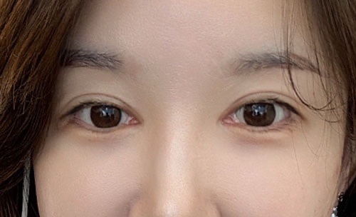 눈재수술 후기