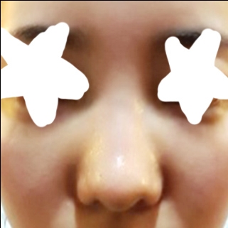 콧대(보형물) 후기