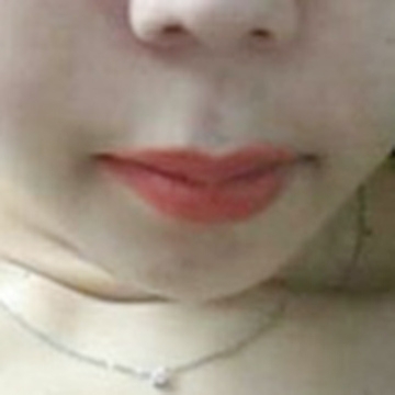 입꼬리성형 후기