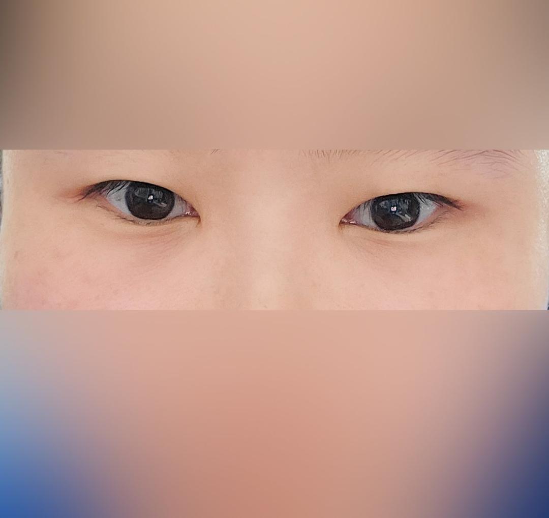 쌍꺼풀(절개) 후기