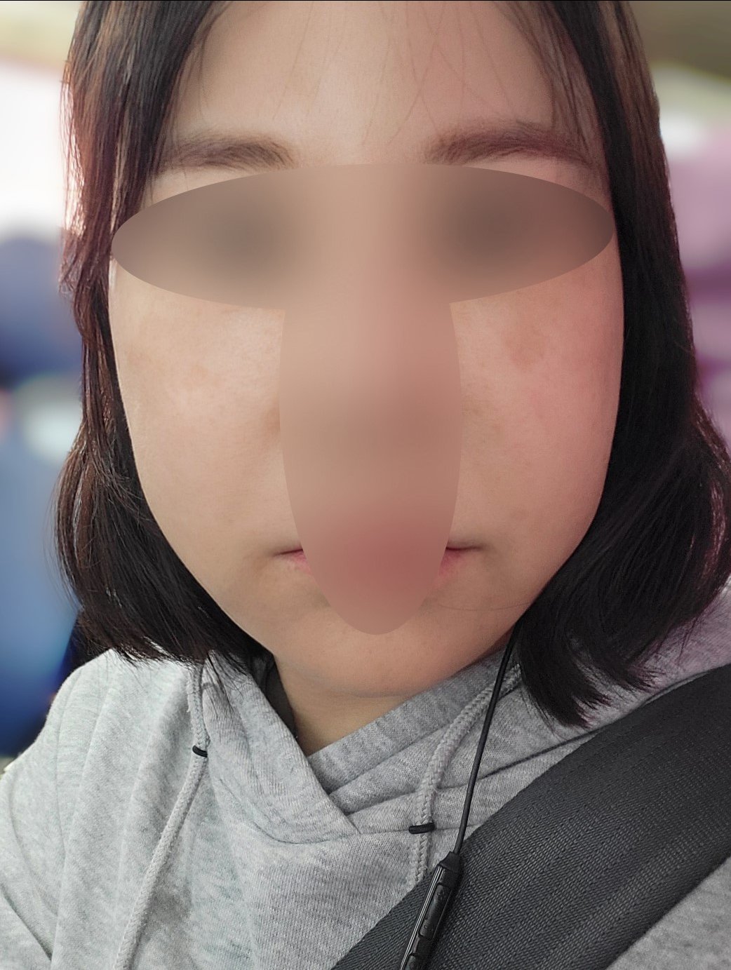 윤곽주사 후기