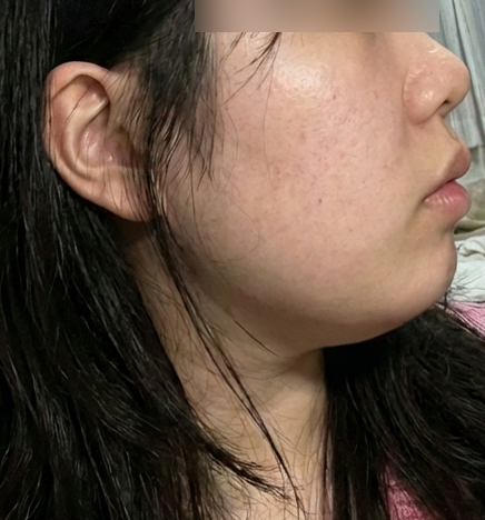 온다리프팅 후기