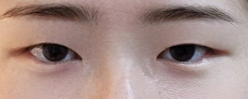 쌍꺼풀(절개) 후기