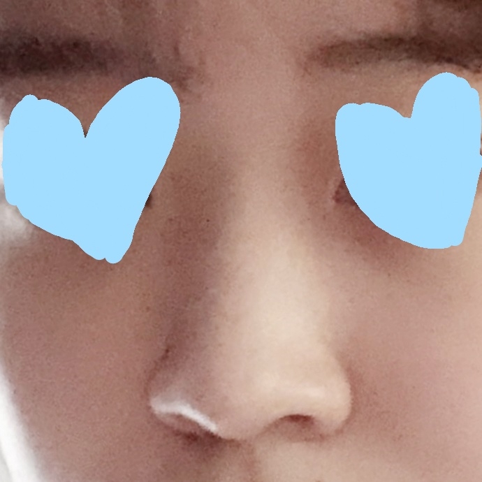 콧대(보형물) 후기